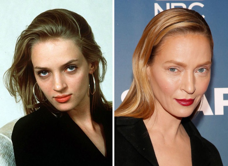 8 Gorgeous Stars Before & After Botox | Her Beauty