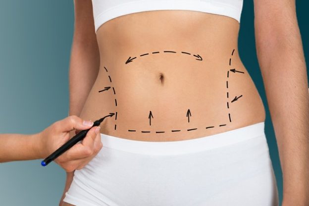 non invasive tummy tuck near me non invasive tummy tuck near me