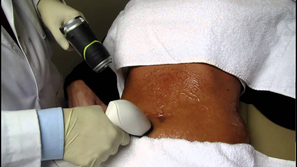 Everything To Know About The Non Surgical Tummy Tuck