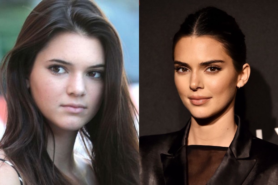 Kendall Jenner’s Plastic Surgery   | 7 Juicy Facts About Kendall Jenner | HerBeauty