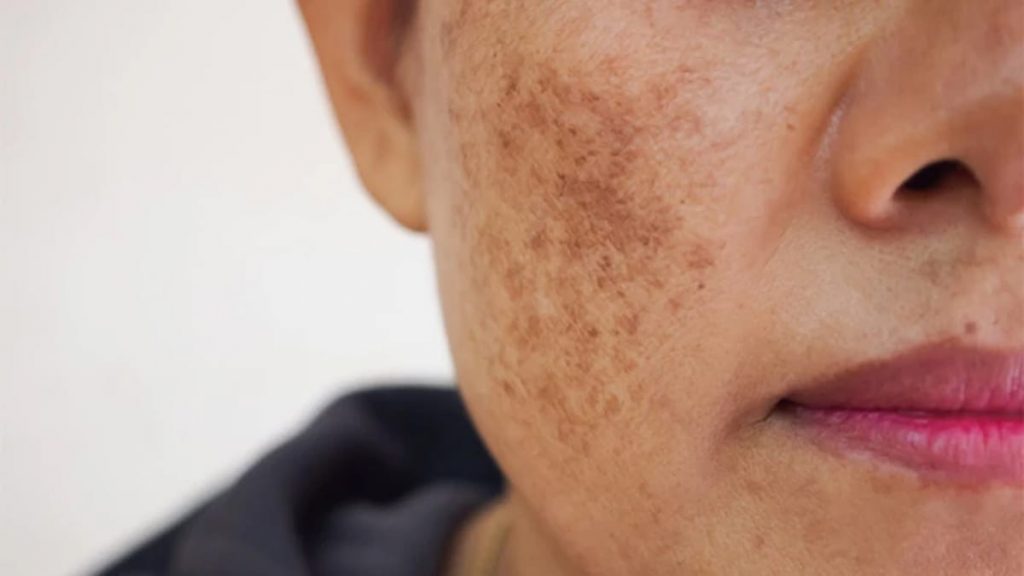 6 Cara Alami Hilangkan Flek Hitam Pada Wajah