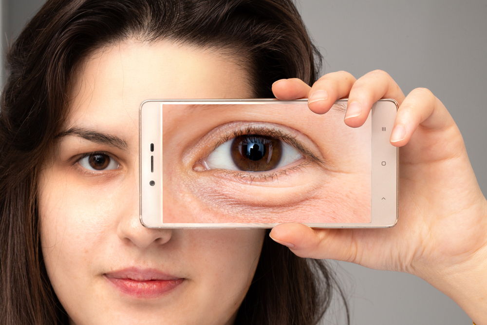 11 Ways to Get Rid of Dark Circles and Bags Under Eyes