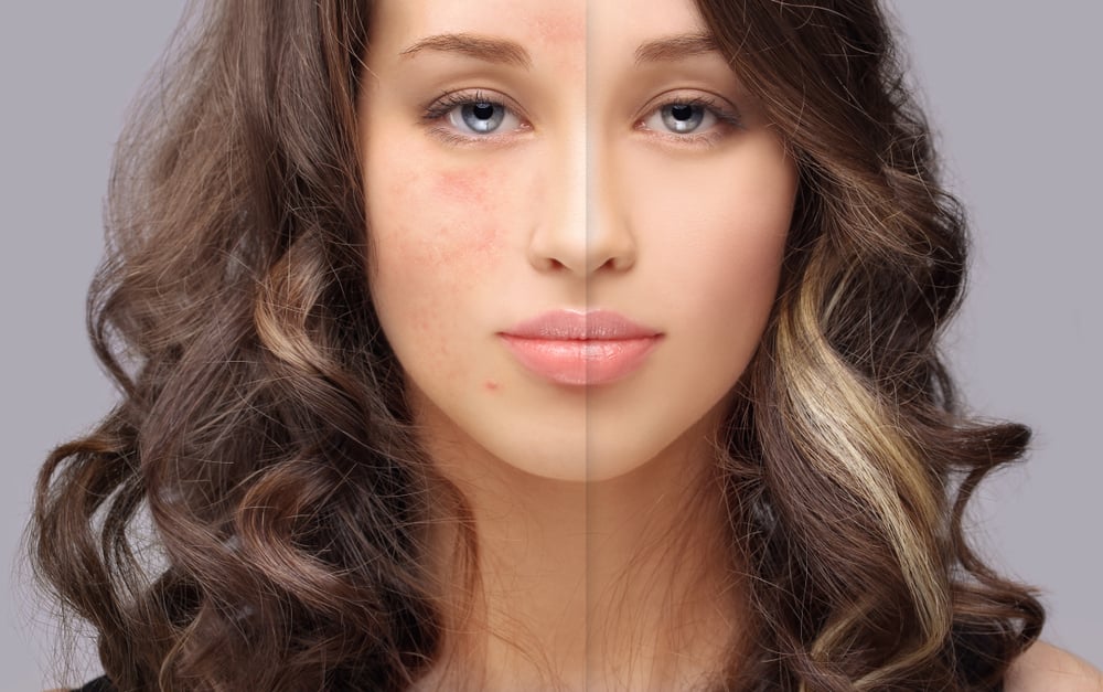 Quais as diferenças entre espinhas e cravos e como tratá-los?