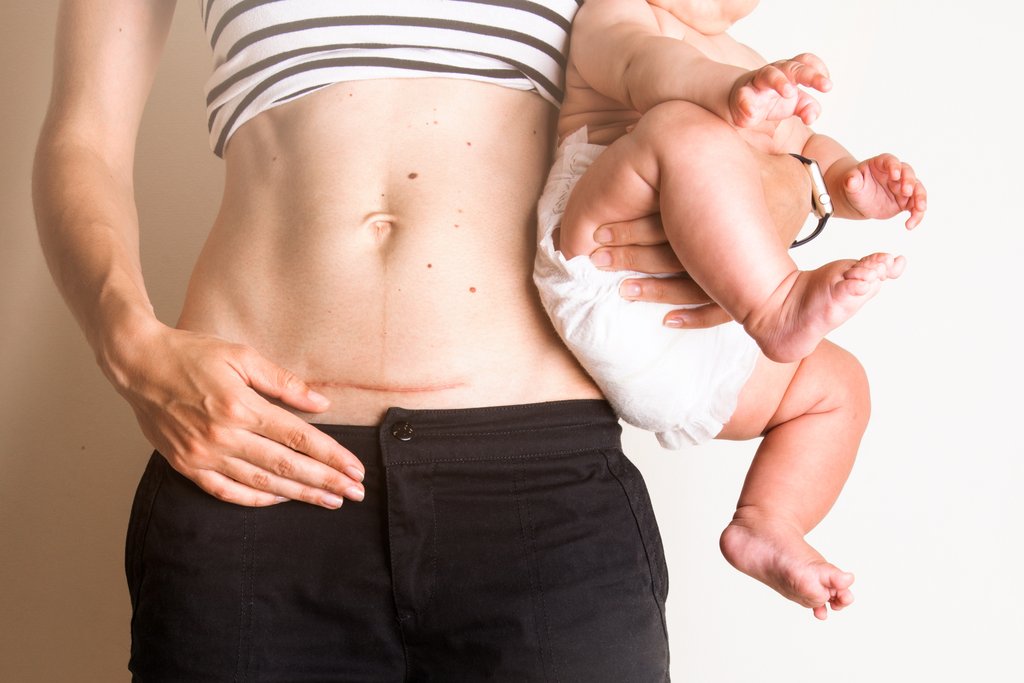 Diastasi addominale: molti ne soffrono senza saperlo
