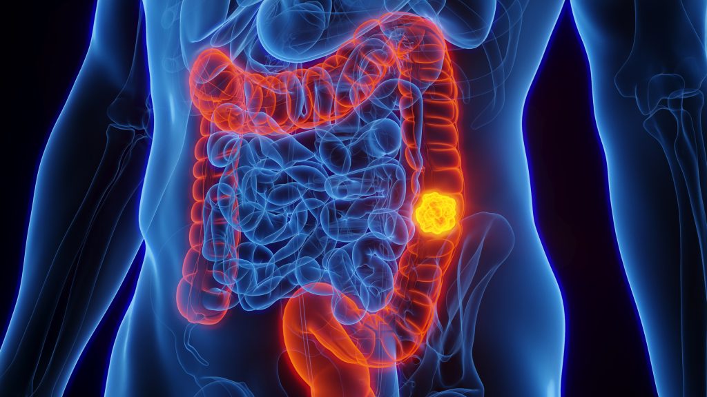 6 cibi che mangiamo ogni giorno che provocano il cancro