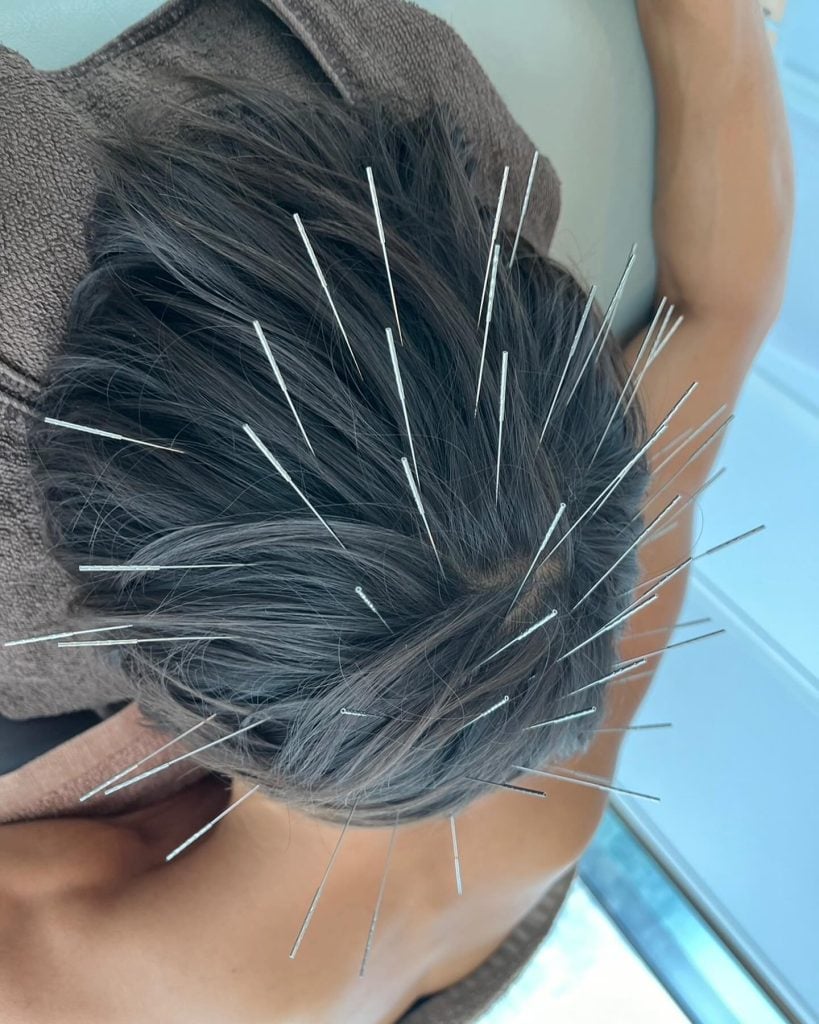 Acupuncture Craze Turns You into a Human Porcupine—But People Love It