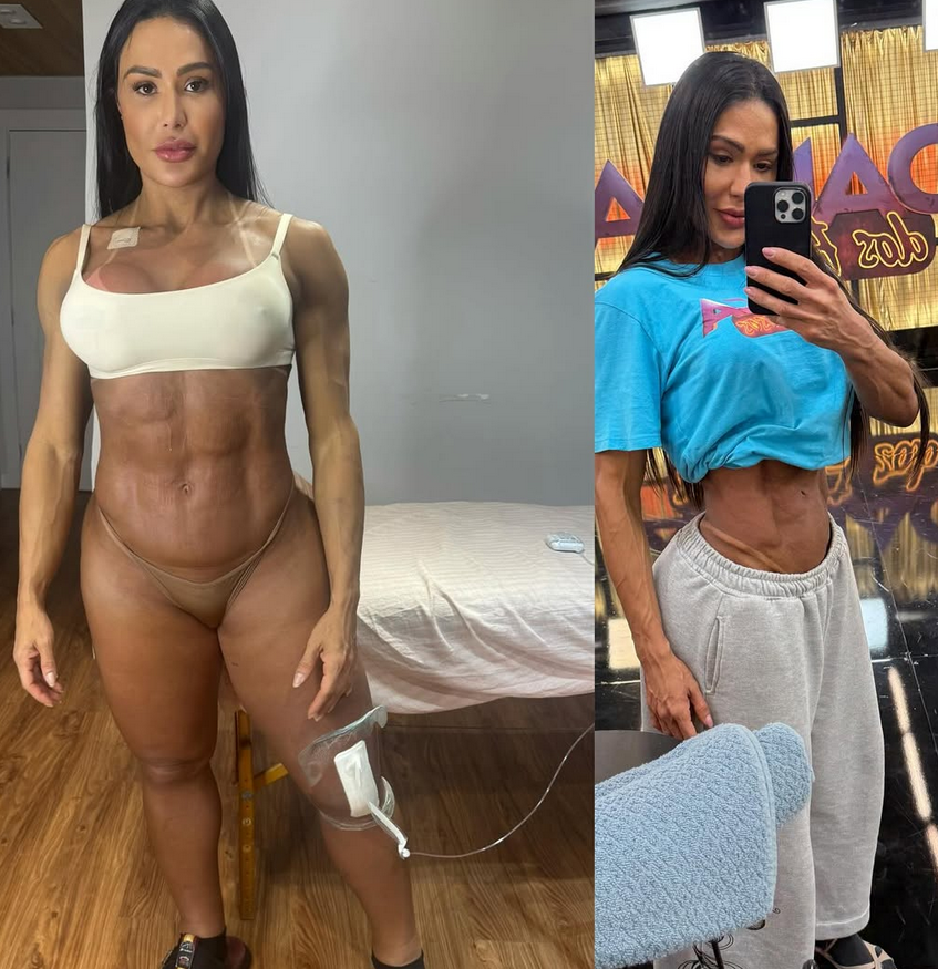 Gracyanne Barbosa fala sobre aparência das pernas após lesão: “Não é sobre beleza”