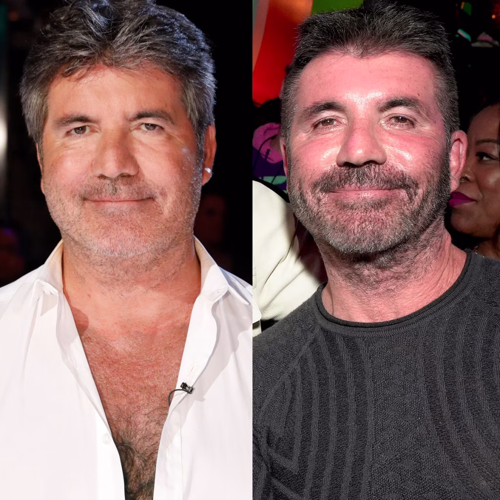 10 Celebs Who Look Way Better After Dissolving Their Filler 
